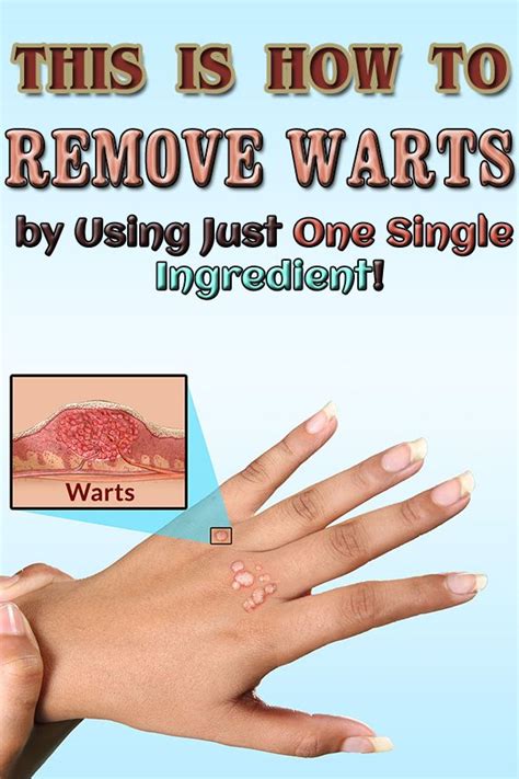 Wart Removal Methods