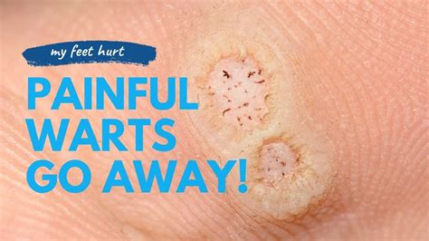 Wart Treatment Tips